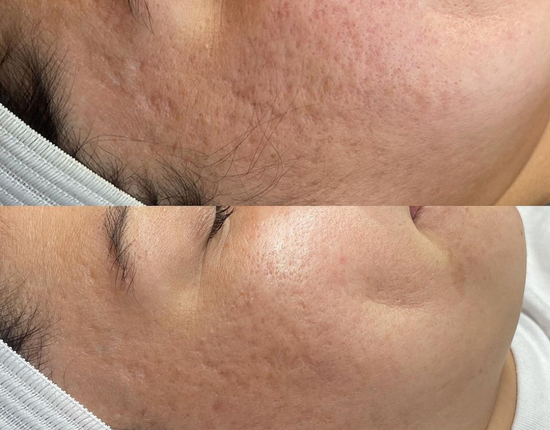 Peeling Chimic