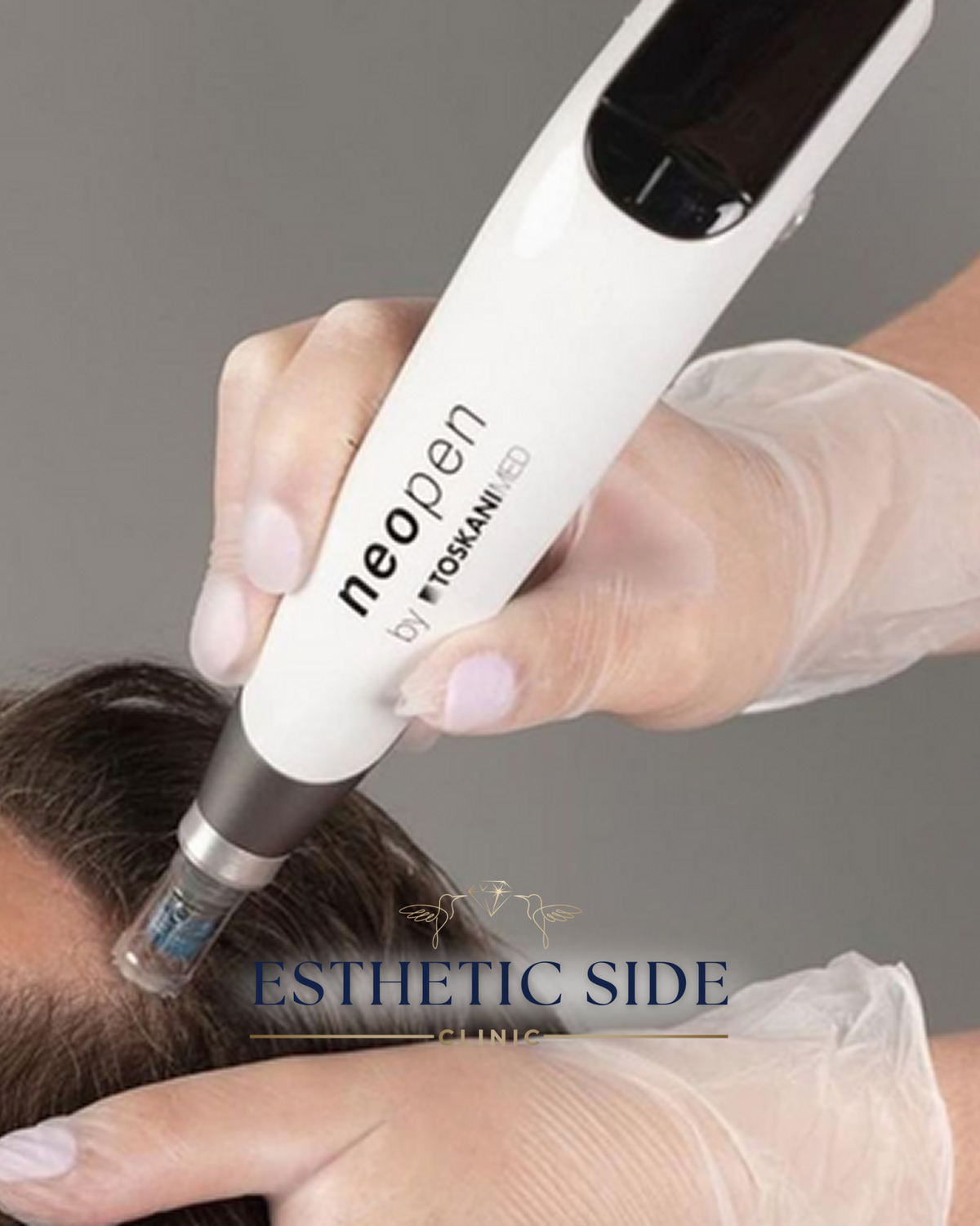 Peeling Chimic